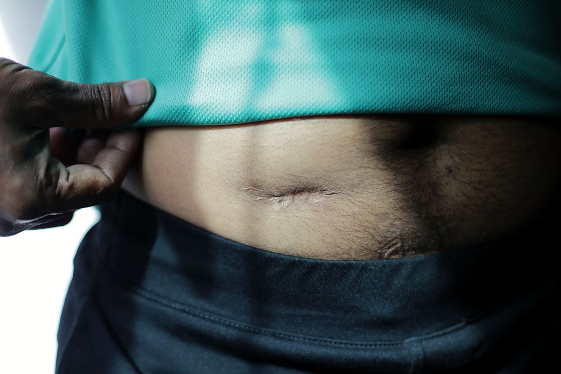 The colorectal cancer survivor underwent radiation therapy and chemotherapy. He had surgery to remove a tumour and 20cm of his colon, and also had a stoma bag attached to his abdomen to help him clear his bowels.